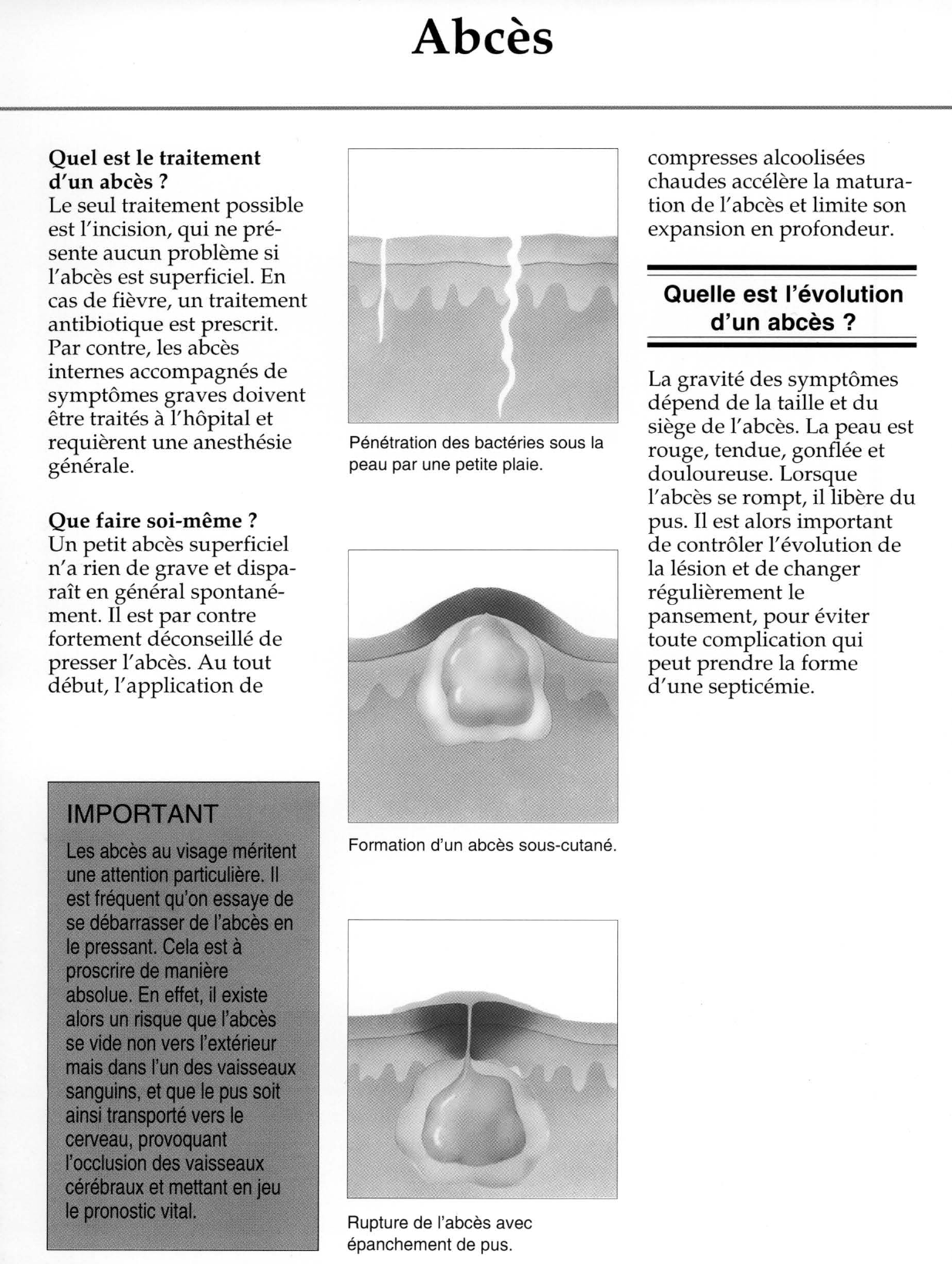 Prévisualisation du document Abcès.