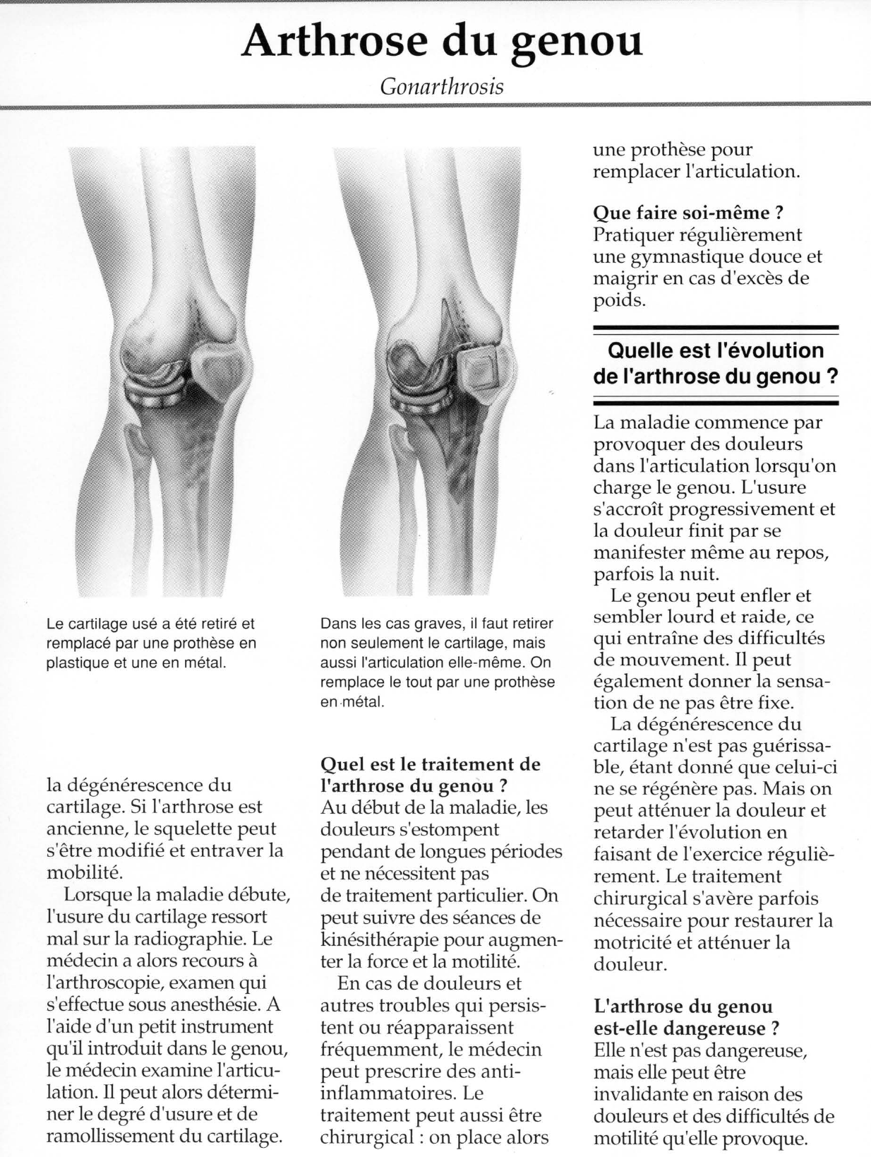 Prévisualisation du document Arthrose du genou.