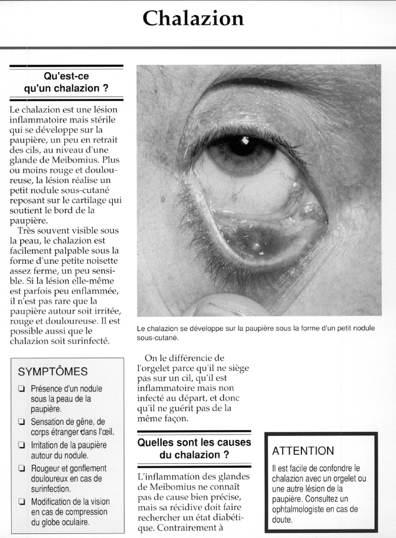Prévisualisation du document Chalazion.