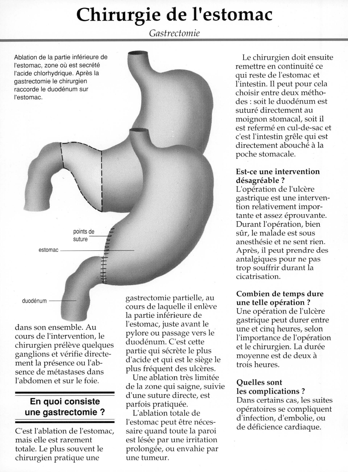 Prévisualisation du document Chirurgie de l'estomac:
Gastrectomie.