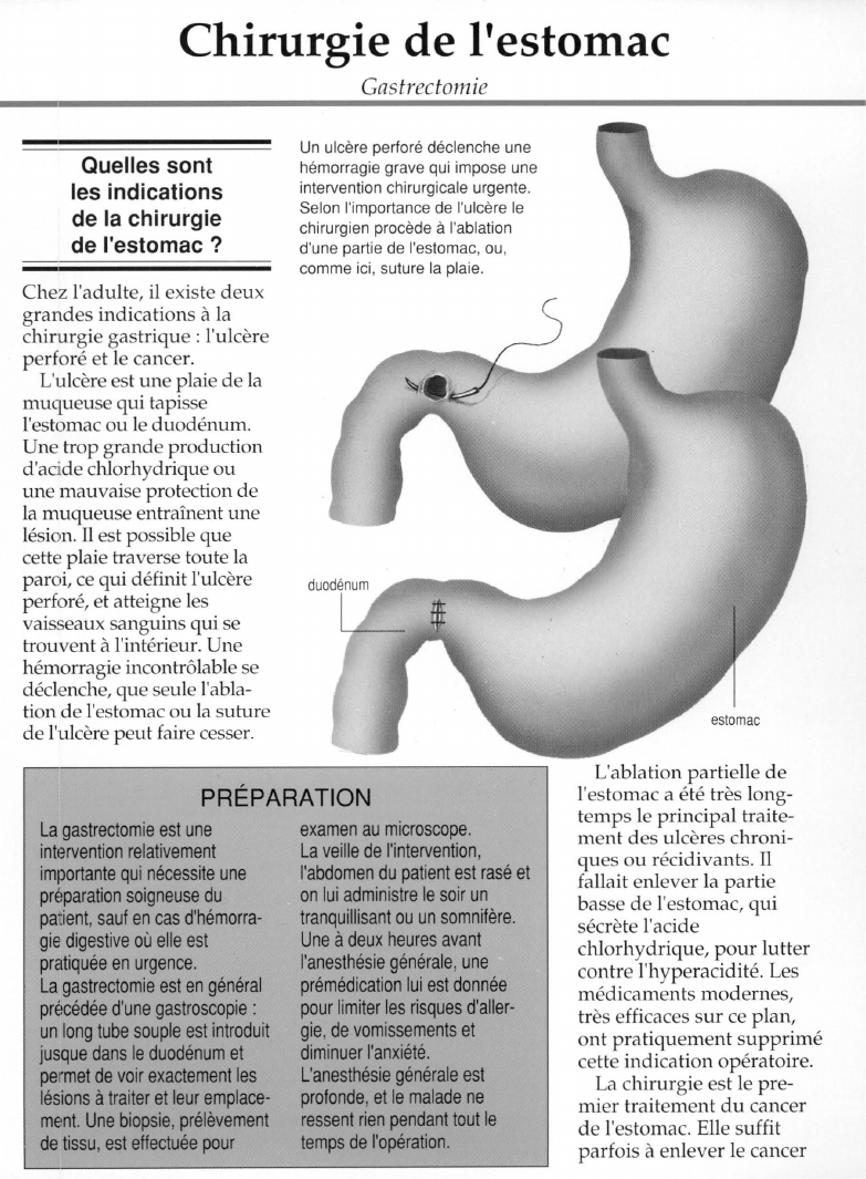 Prévisualisation du document Chirurgie de l'estomac:Gastrectomie.