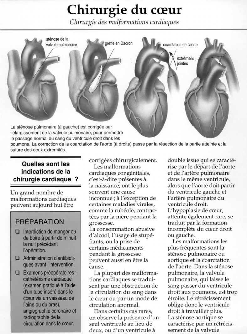 Prévisualisation du document Chirurgie du coeur/Chirurgie des malformations cardiaques	La sténose pulmonaire (à gauche) est corrigée par l'élargissement de la valvule pulmonaire, pour permettre le passage normal du sang du ventricule droit dans lespoumons.