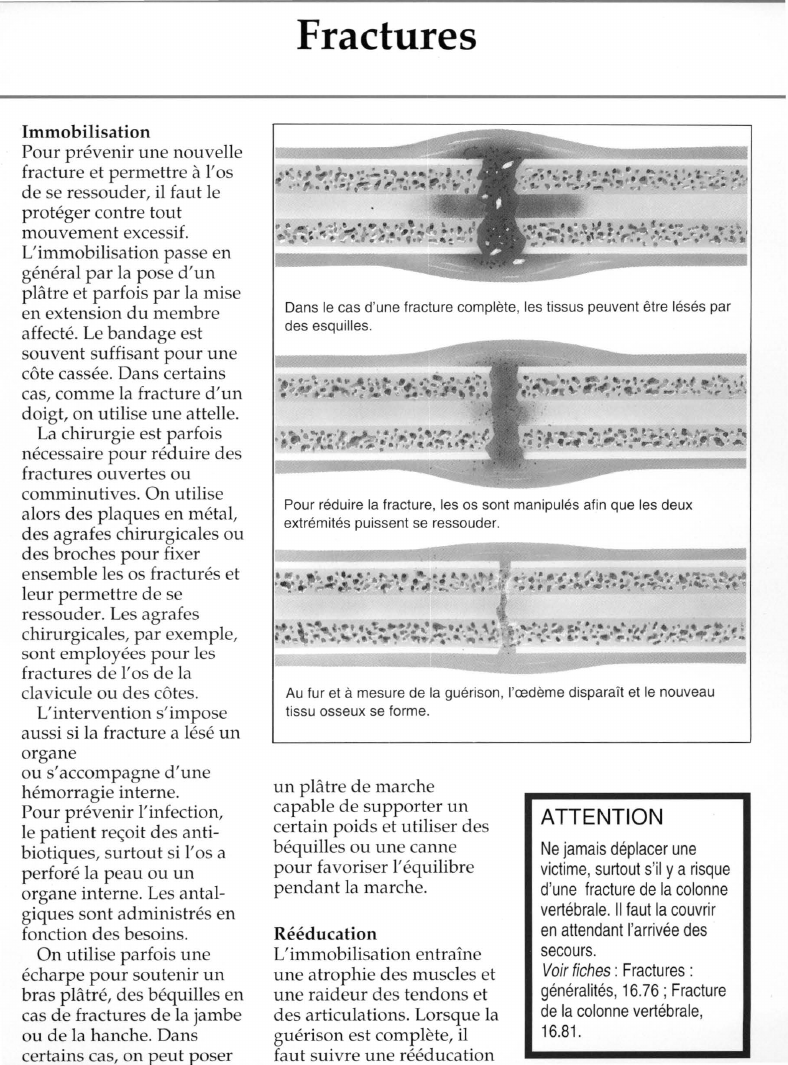 Prévisualisation du document Fractures.