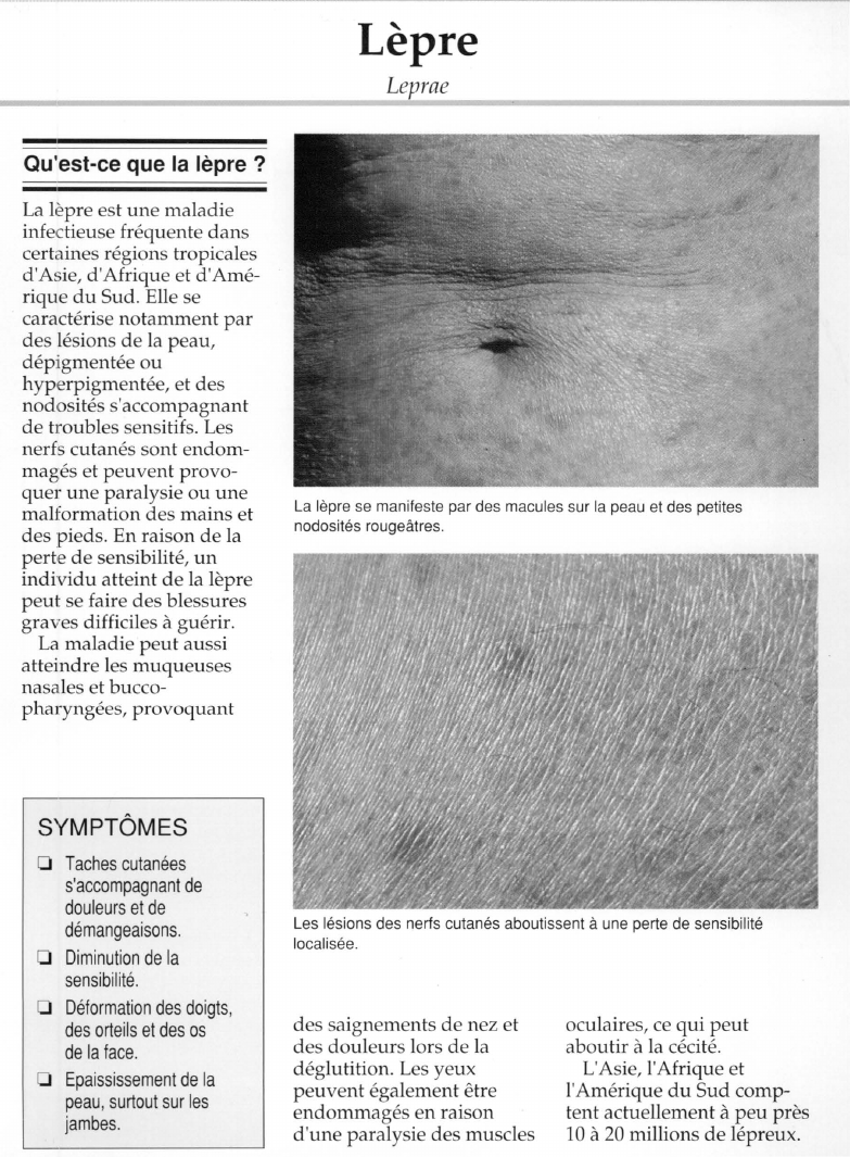 Prévisualisation du document La Lèpre.