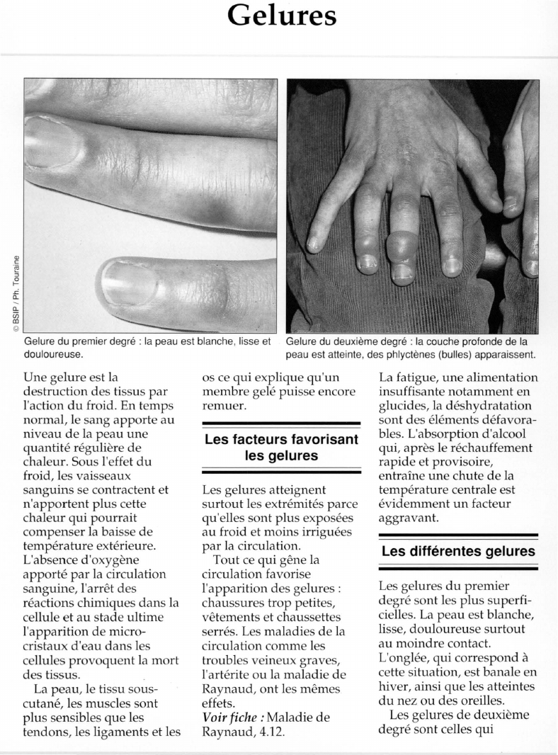 Prévisualisation du document Les Gelures.