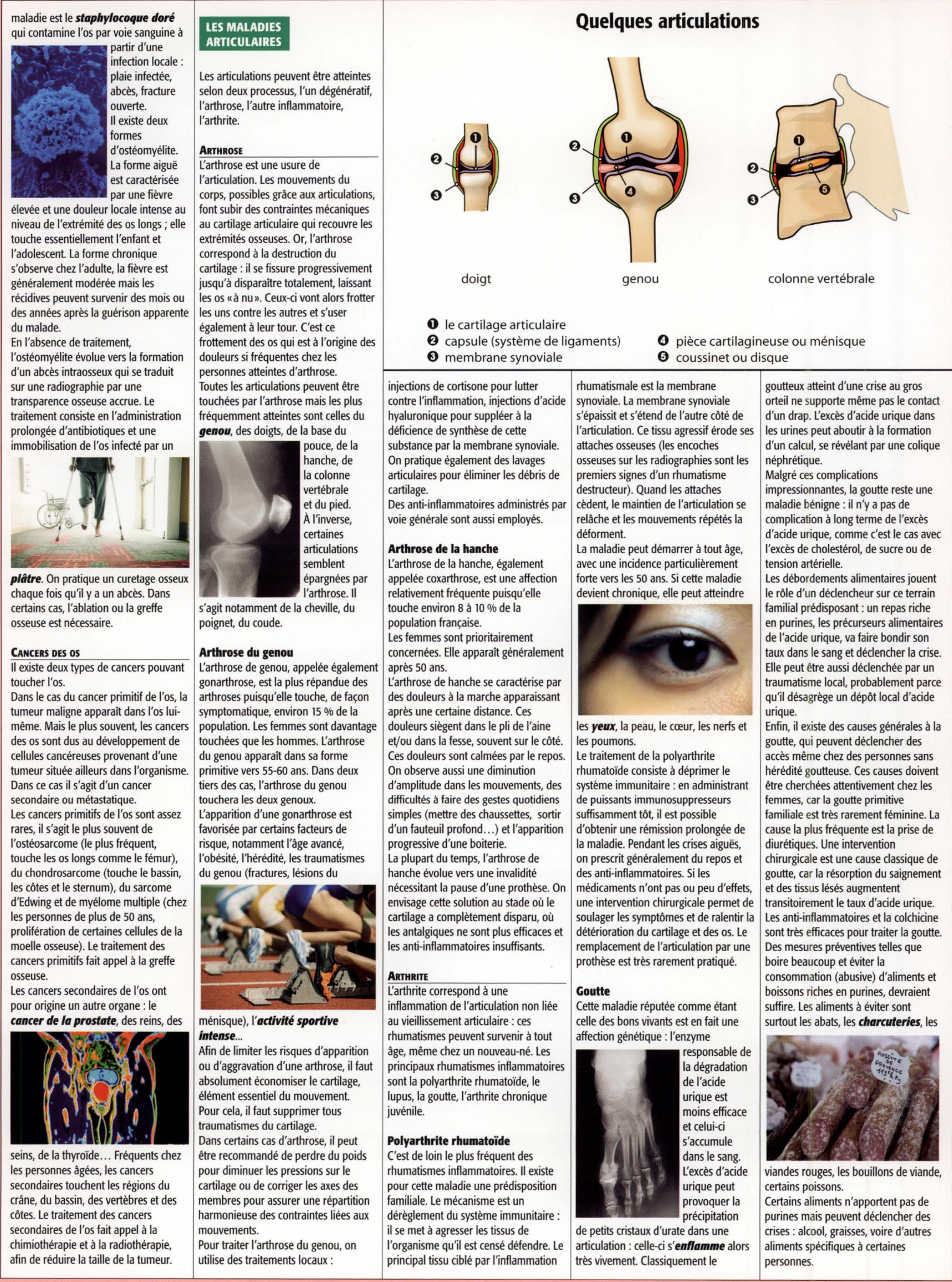 Prévisualisation du document LES MALADIES DES OS ET DES ARTICULATIONS (Travaux Personnels Encadrés – Médecine & Santé  – TS)