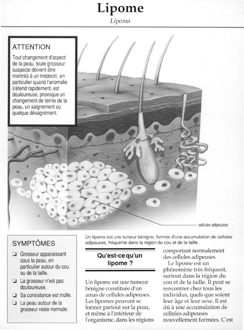 Prévisualisation du document Lipome.