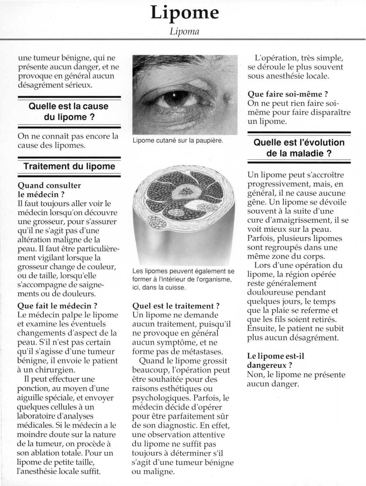 Prévisualisation du document Lipome.