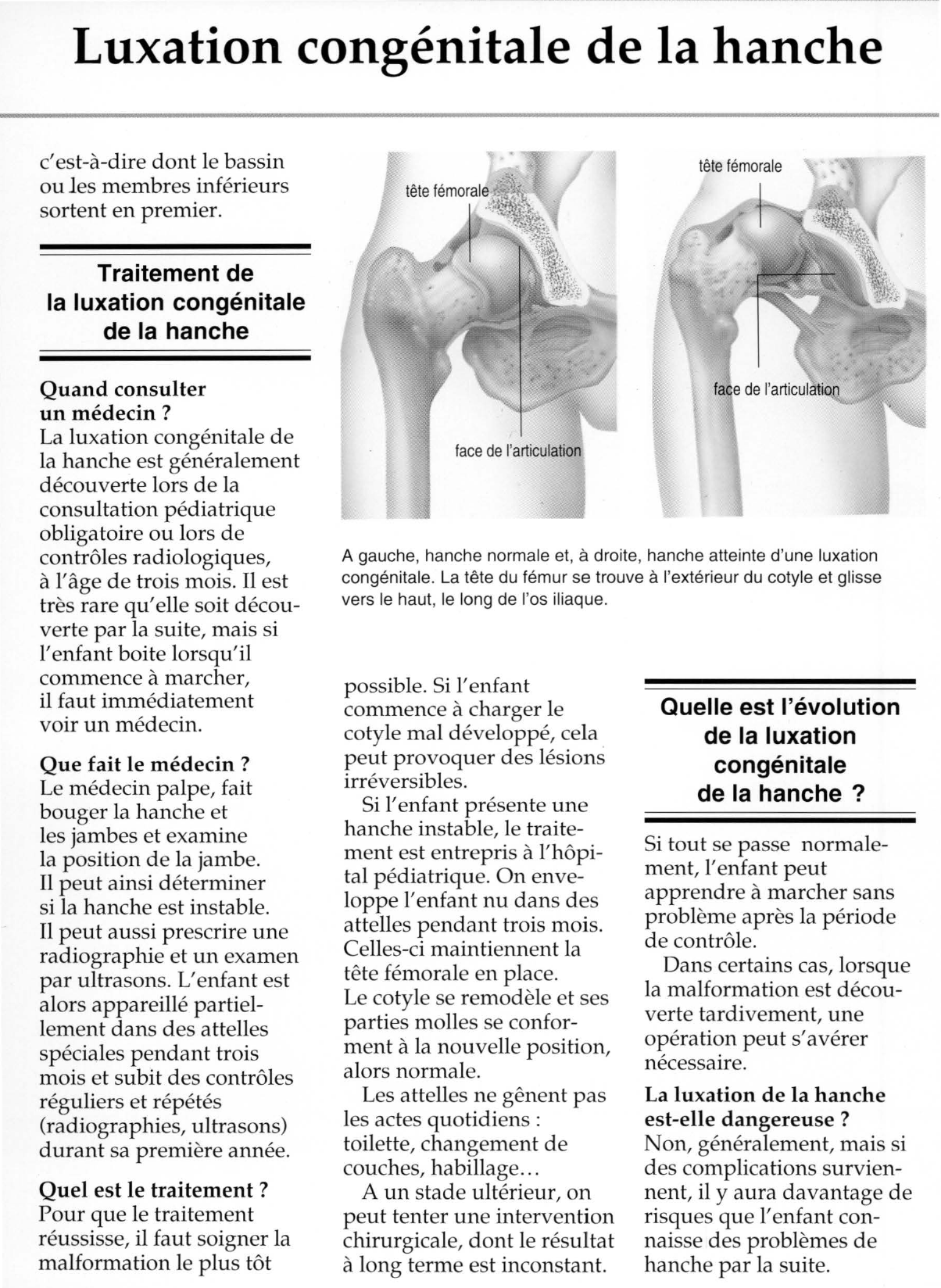Prévisualisation du document Luxation congénitale de la hanche.