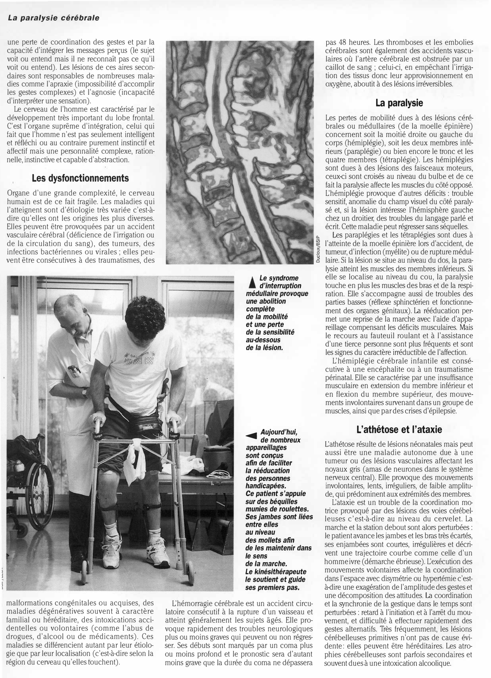 Prévisualisation du document Médecine LA PARALYSIE CÉRÉBRALE
