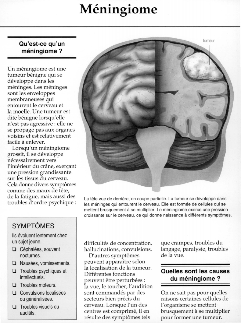 Prévisualisation du document Méningiome.