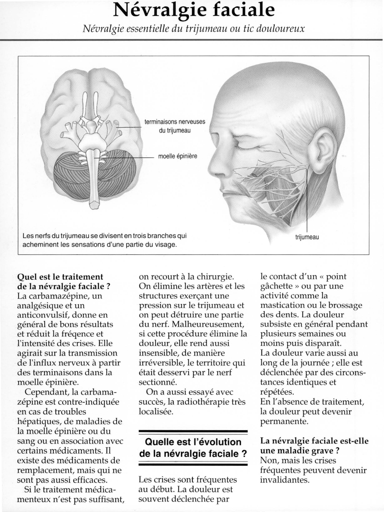 Prévisualisation du document Névralgie faciale.