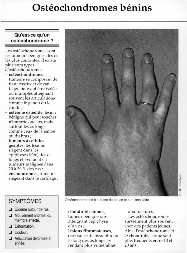 Prévisualisation du document Ostéochondromes bénins:Qu'est-ce qu'unostéochondrome ?
