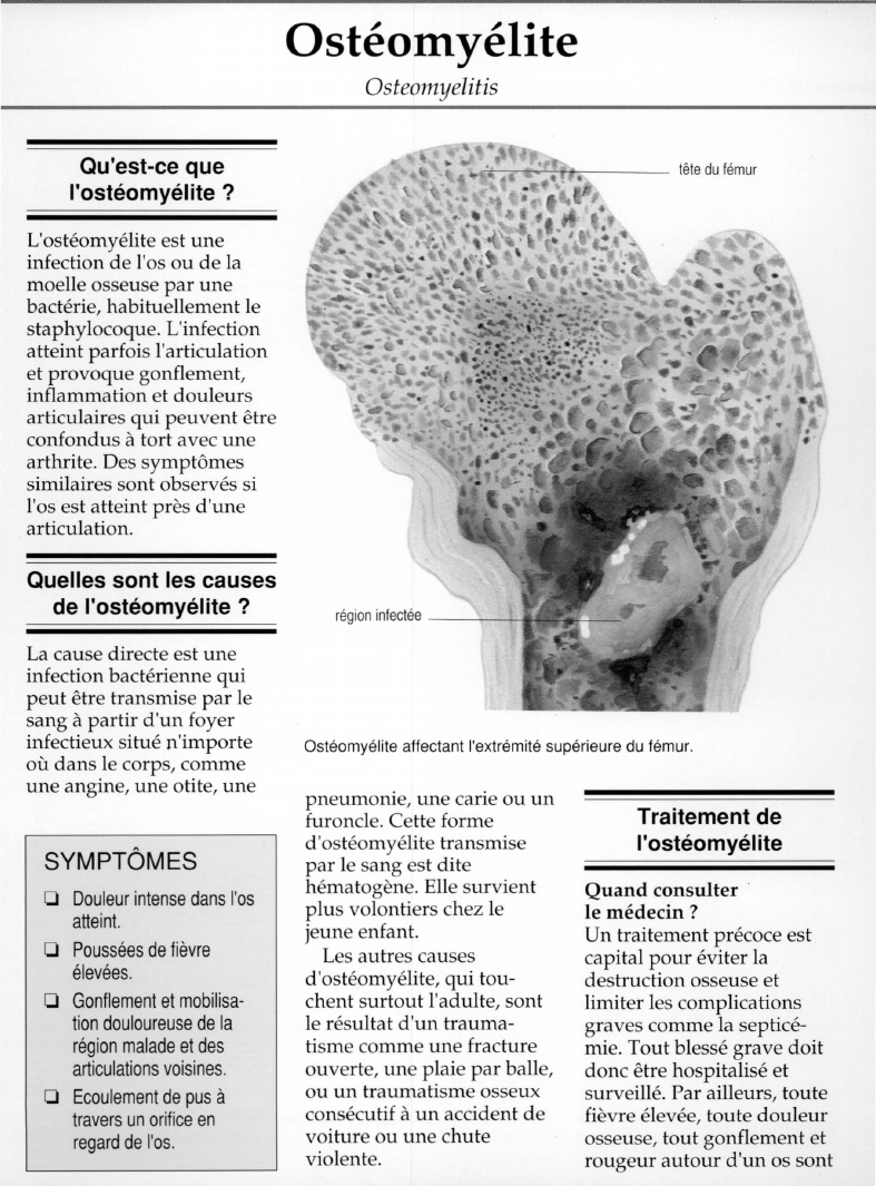 Prévisualisation du document Ostéomyélite.