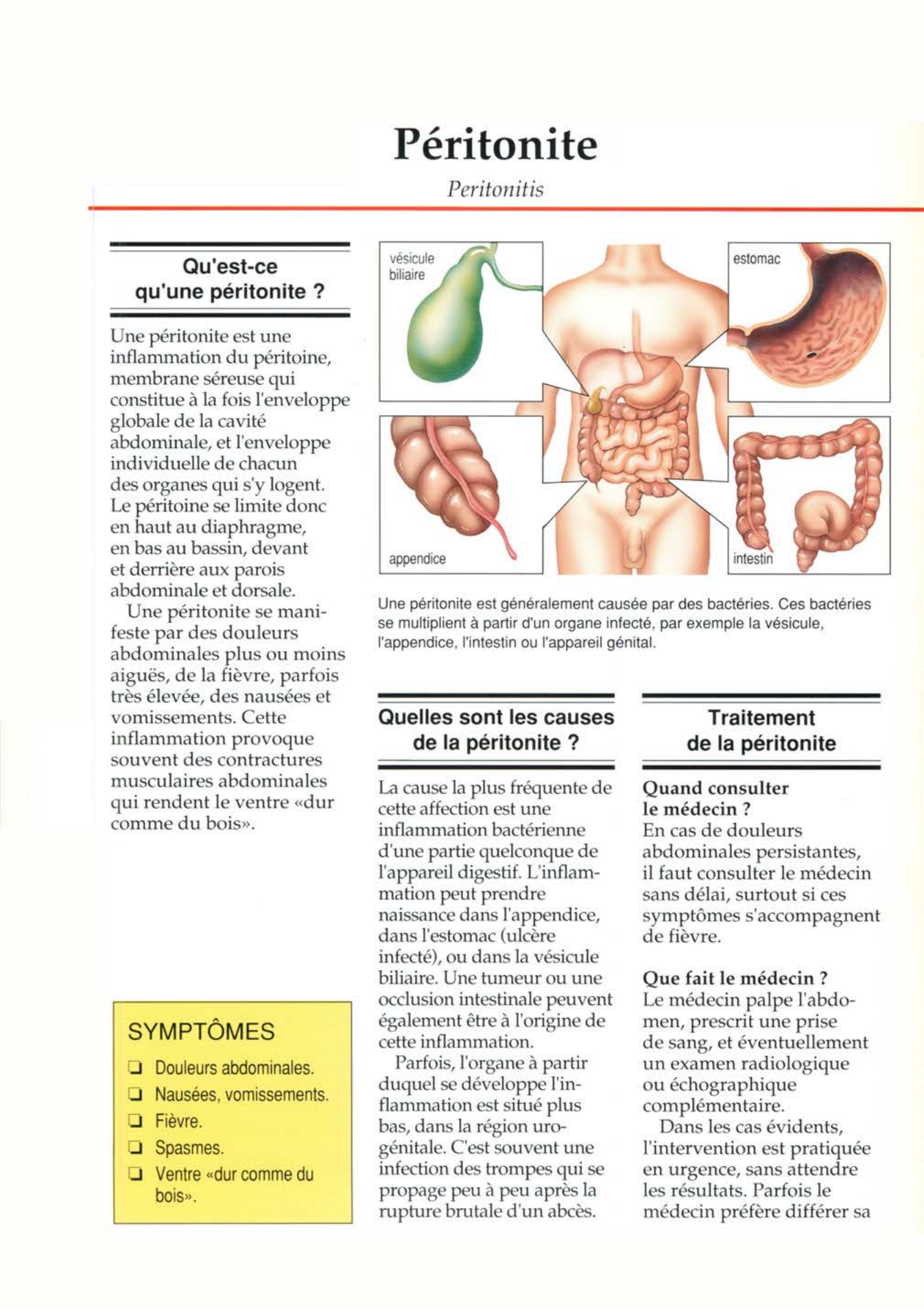 Prévisualisation du document Péritonite