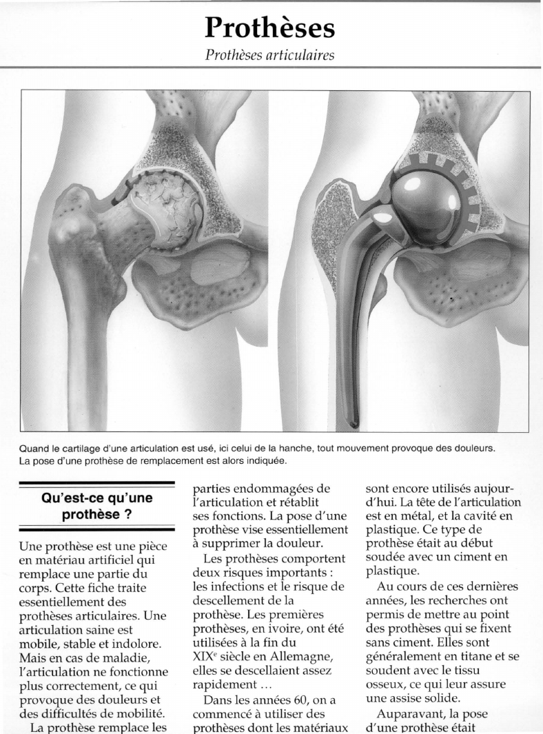 Prévisualisation du document Prothèses:Prothèses articulaires.