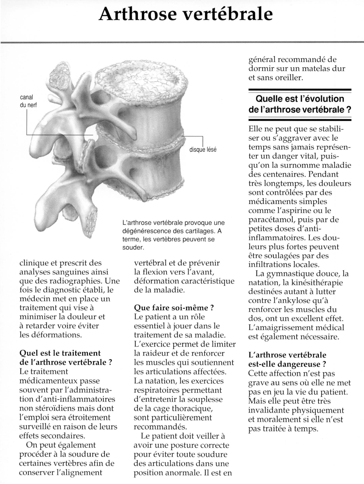 Prévisualisation du document Qu'est-ce que l'arthrose vertébrale ?