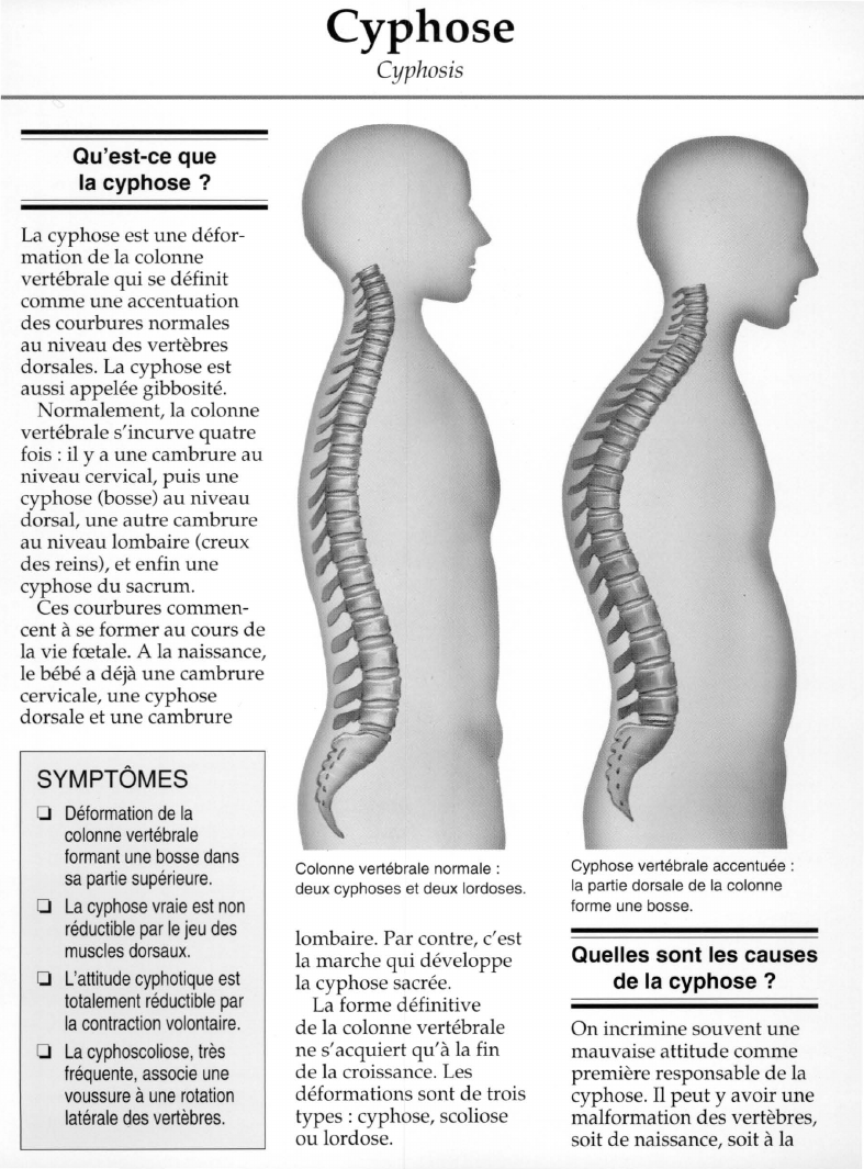 Prévisualisation du document Qu'est-ce quela cyphose ?