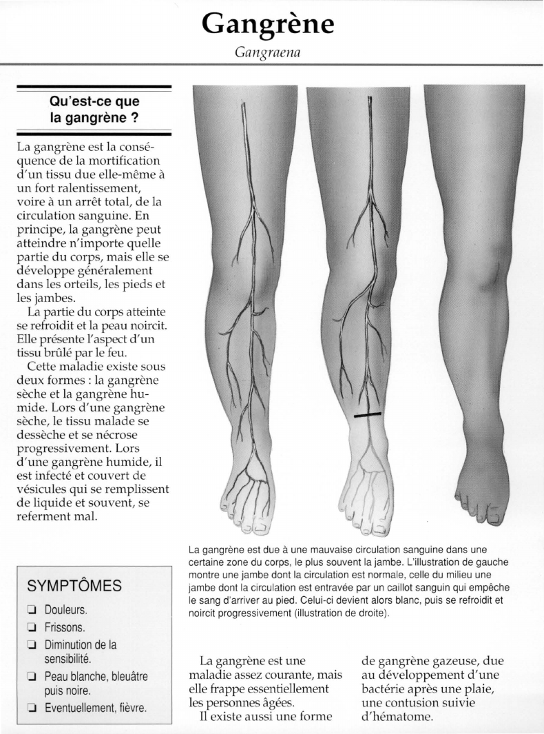 Prévisualisation du document Qu'est-ce que	la gangrène ?