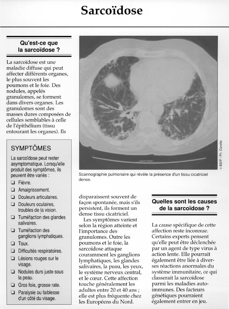 Prévisualisation du document Qu'est-ce quela sarcoïdose ?
