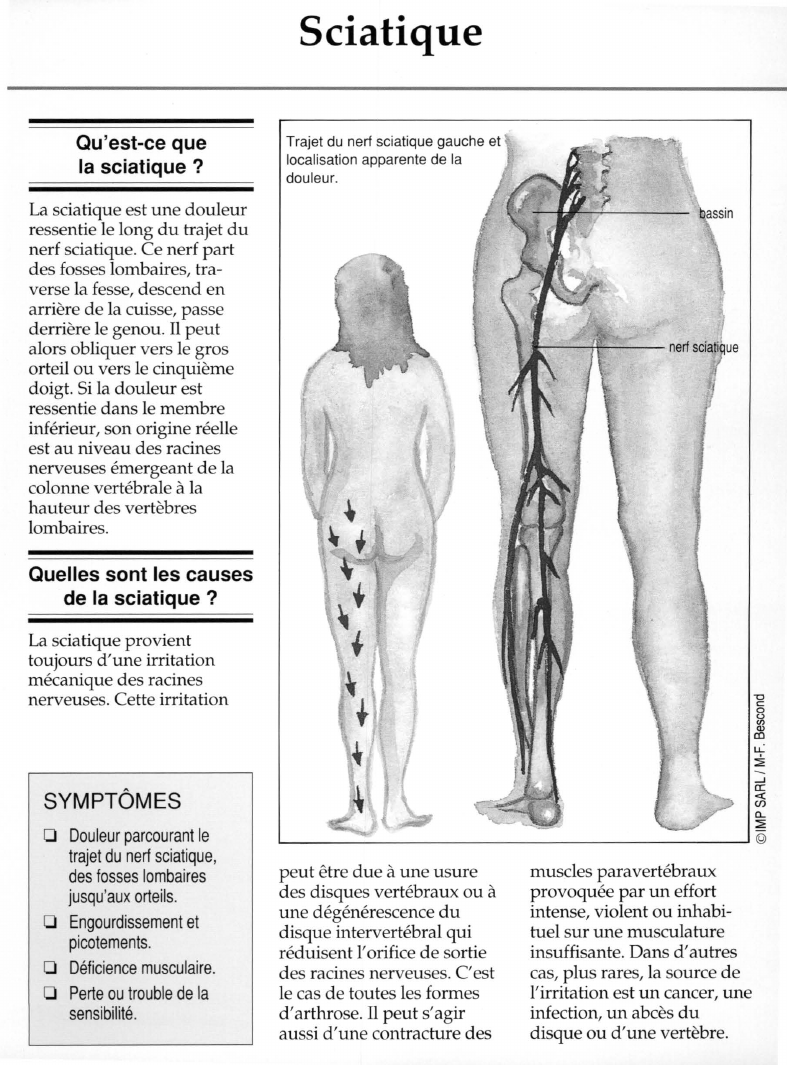 Prévisualisation du document Qu'est-ce quela sciatique ?