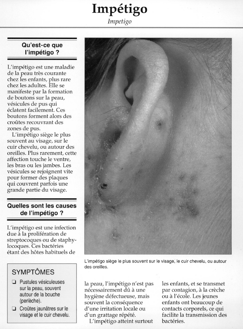 Prévisualisation du document Qu'est-ce que	l'impétigo ?