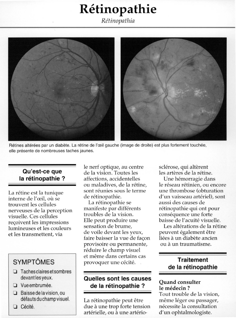 Prévisualisation du document Rétinopathie.