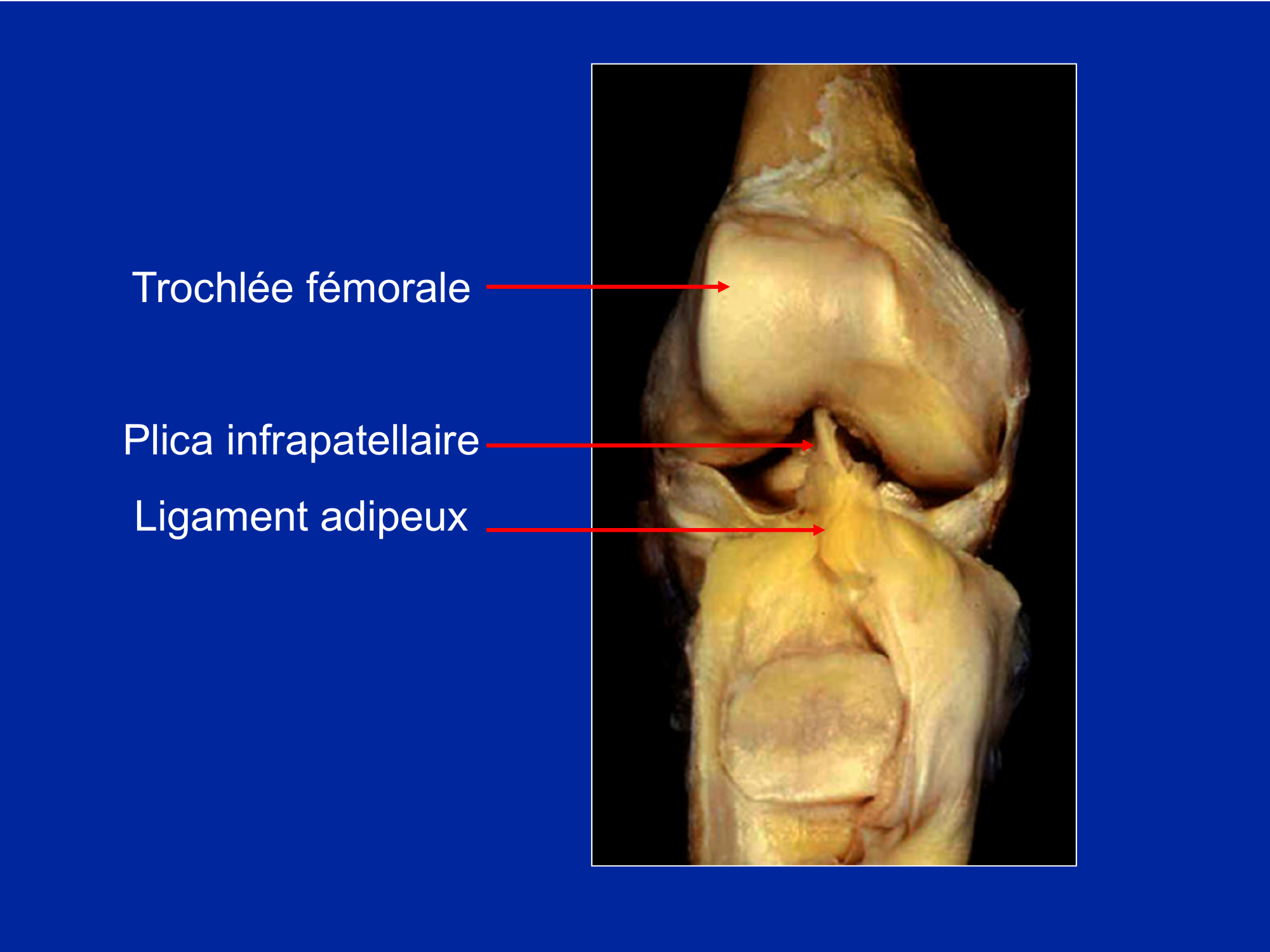 Prévisualisation du document Ruptures des
ligaments du genou

Trochlée fémorale

Plica infrapatellaire
Ligament adipeux

Face externe de la