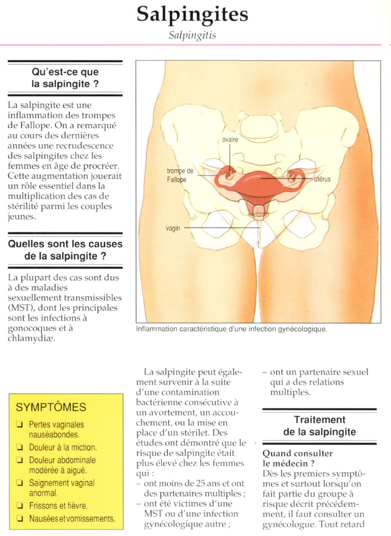 Prévisualisation du document Salpingites