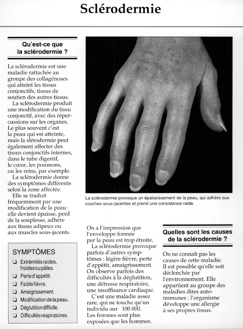 Prévisualisation du document Sclérodermie.