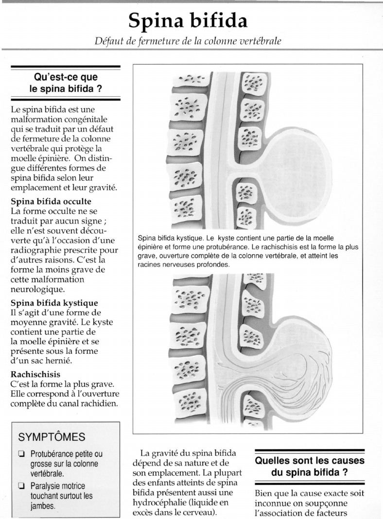 Prévisualisation du document Spina bifida.