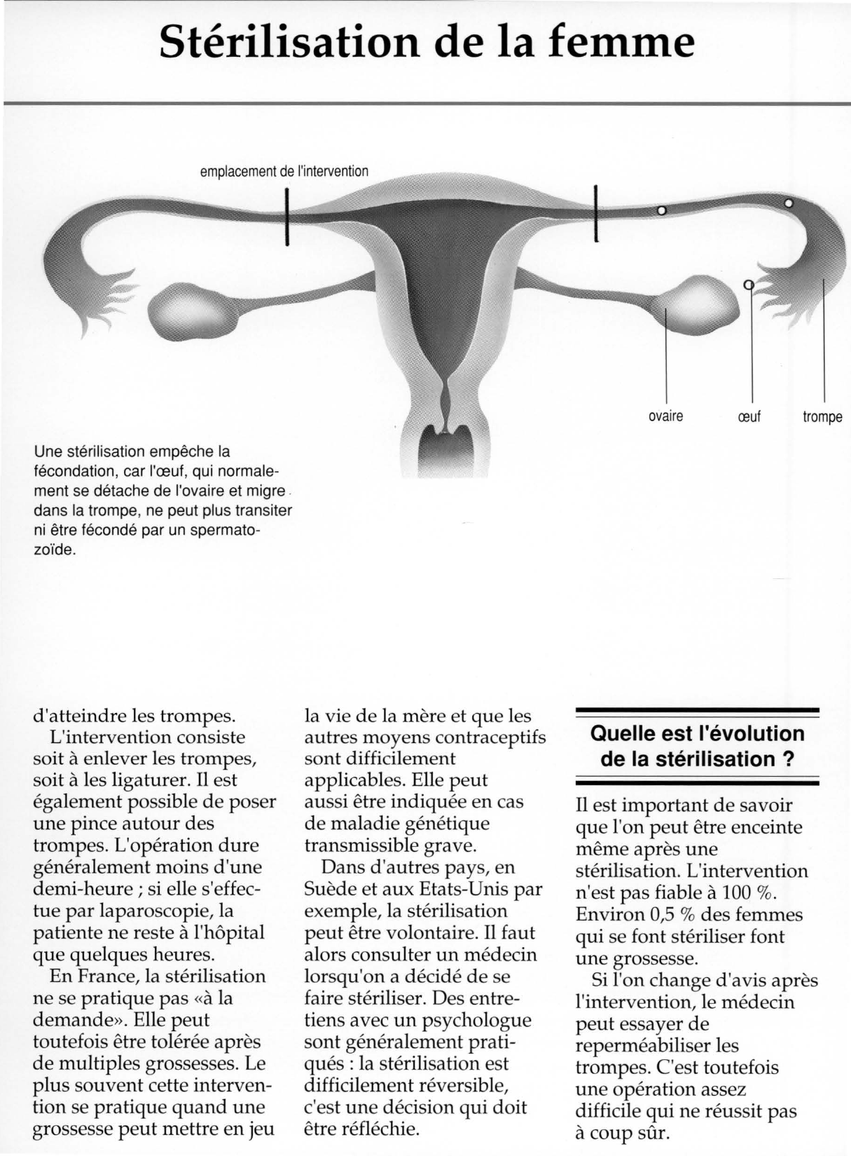 Prévisualisation du document Stérilisation de la femme.