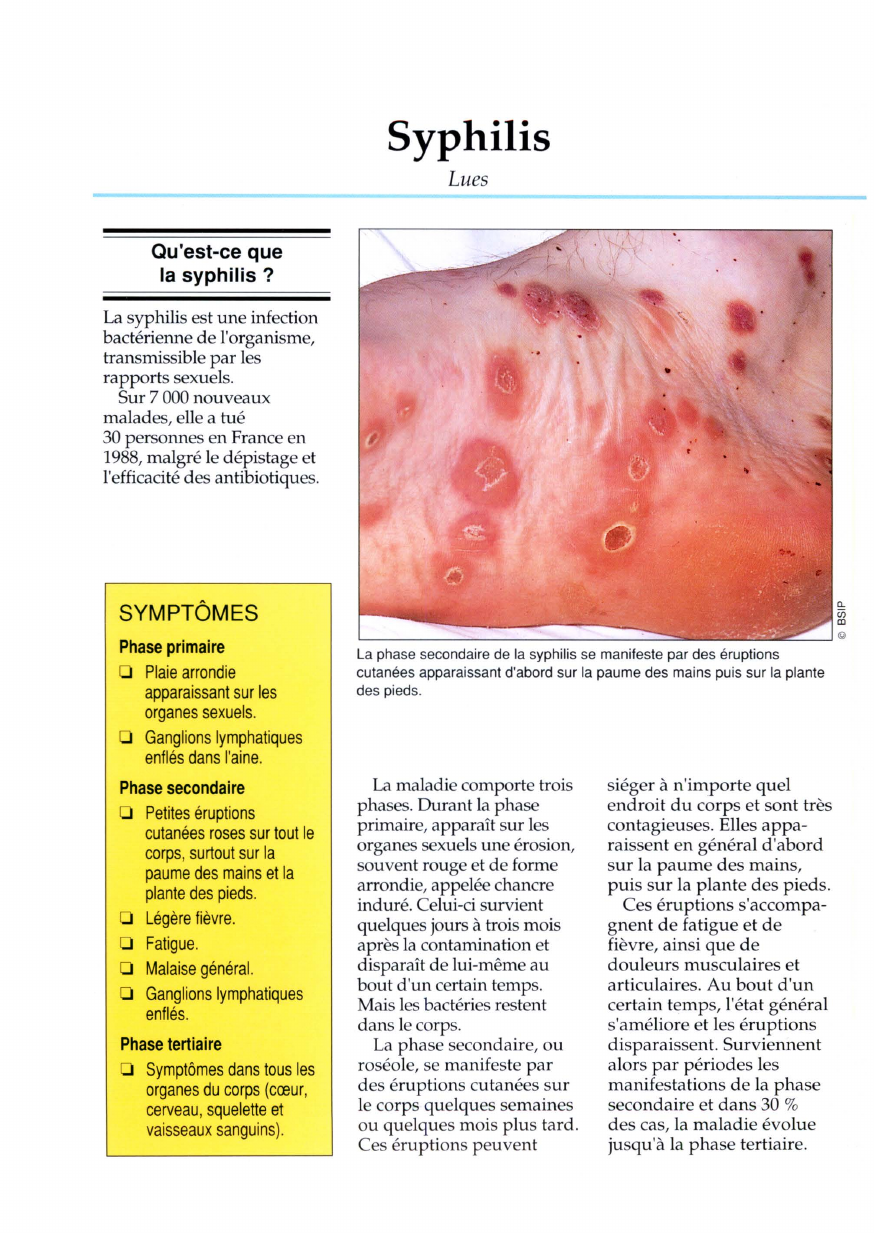 Prévisualisation du document Syphilis - Lues