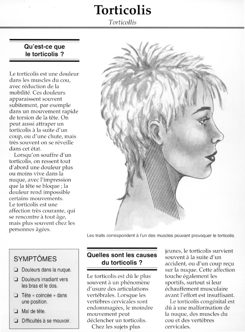 Prévisualisation du document Torticolis.